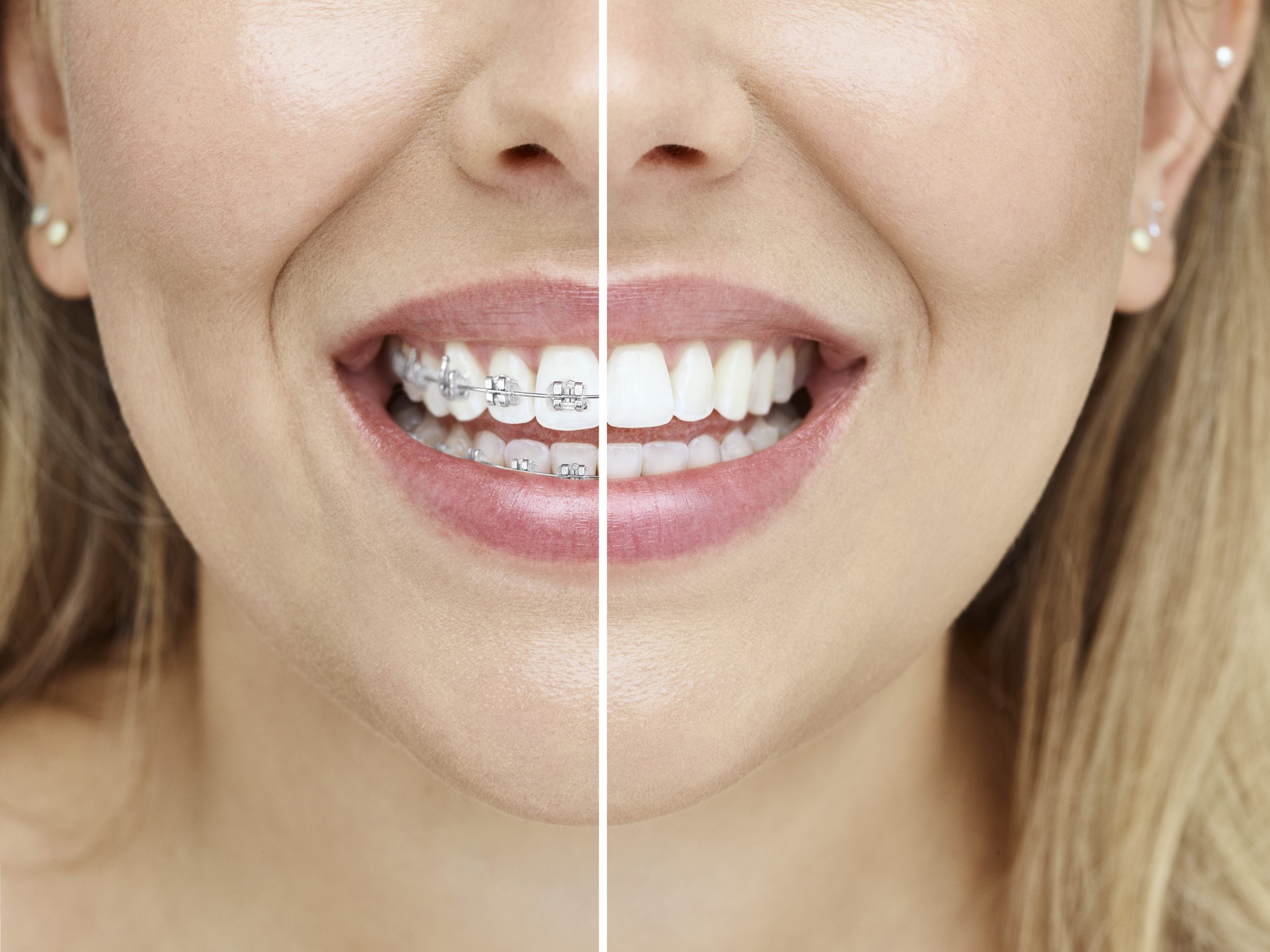 Invisalign Side By Side